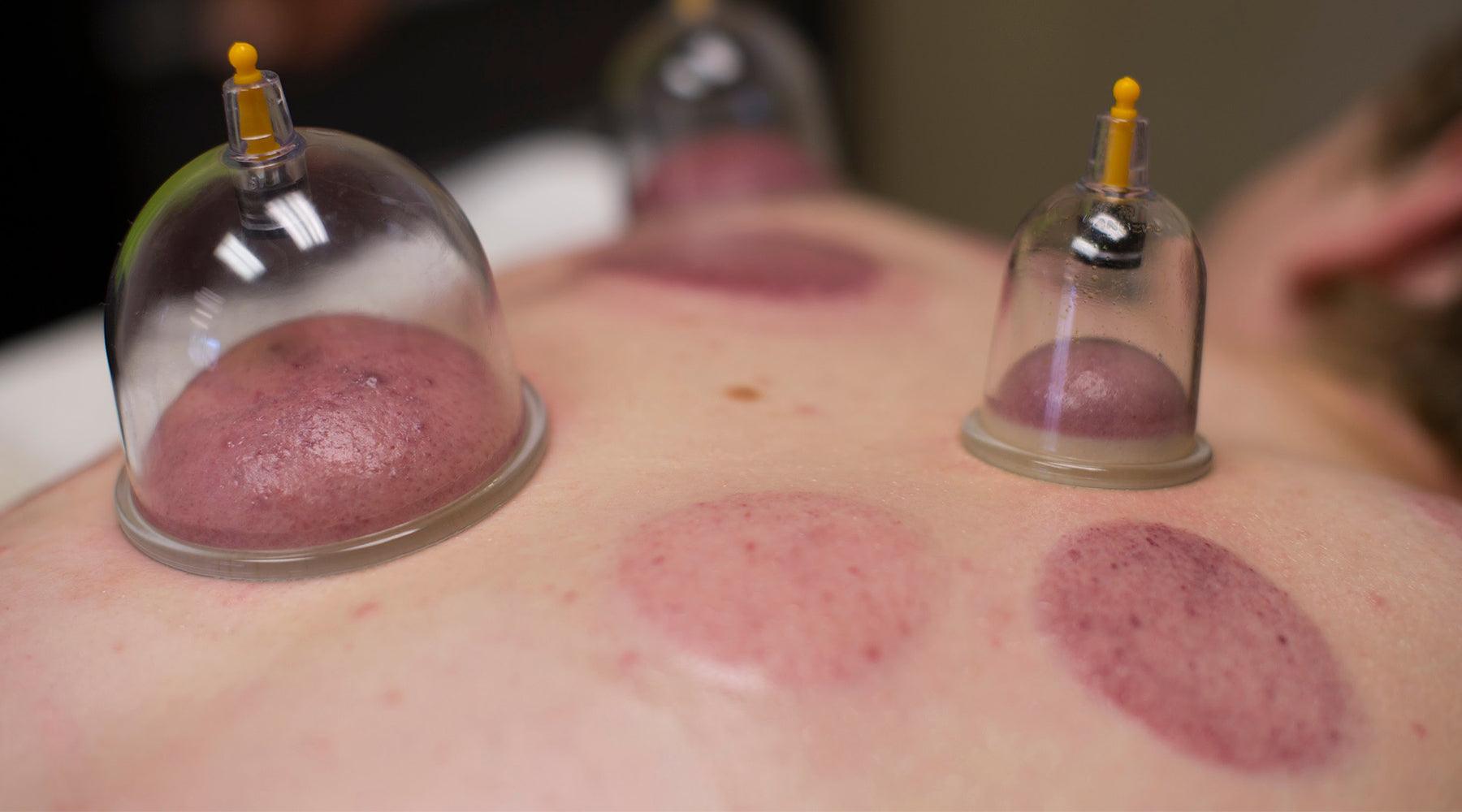 The Benefits of Cupping Therapy and Why You Need Cupping in Your Life - Forever Aesthetic Company